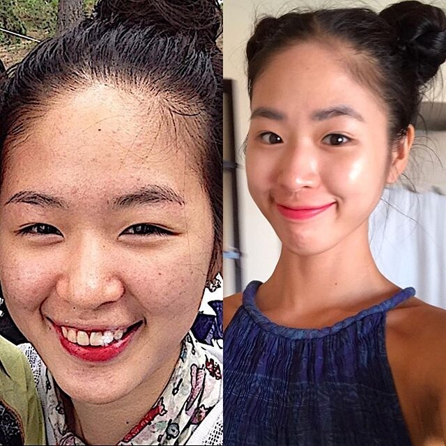 崔高恩的減肥後,擁有辣妹身材外,連豆皮面都清走了 崔高恩的減肥後,擁有辣妹身材外,連豆皮面都清走了