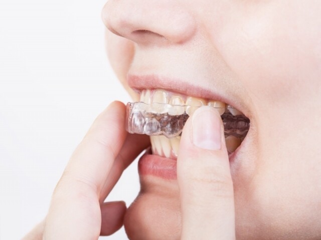 箍牙是否一定要剝牙？關於隱形牙箍的 12 大常見問題，箍牙價錢低至萬多元！