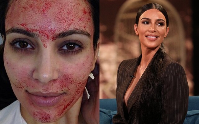 Kim Kardashian 「Vampaire Facial」