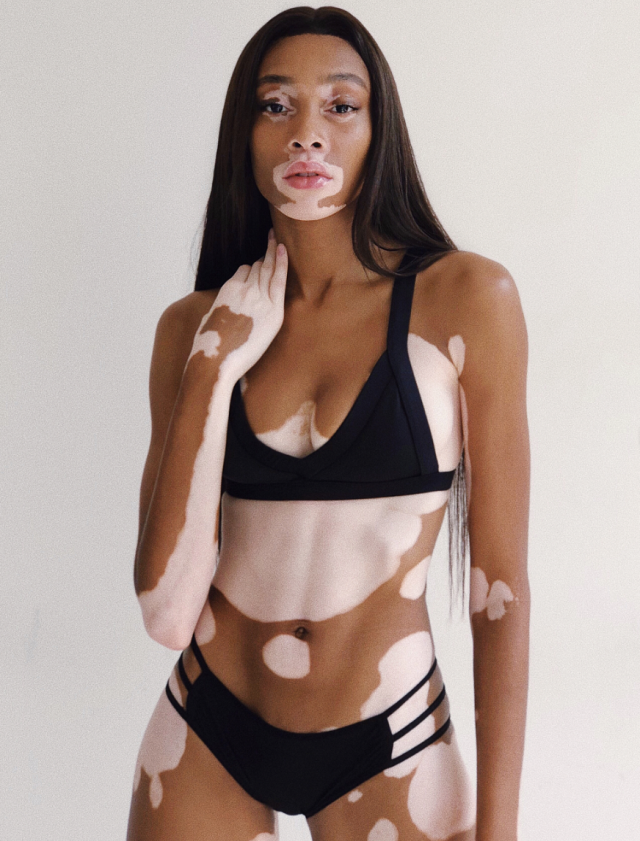Victoria's Secret 時裝騷新面孔： Winnie Harlow
